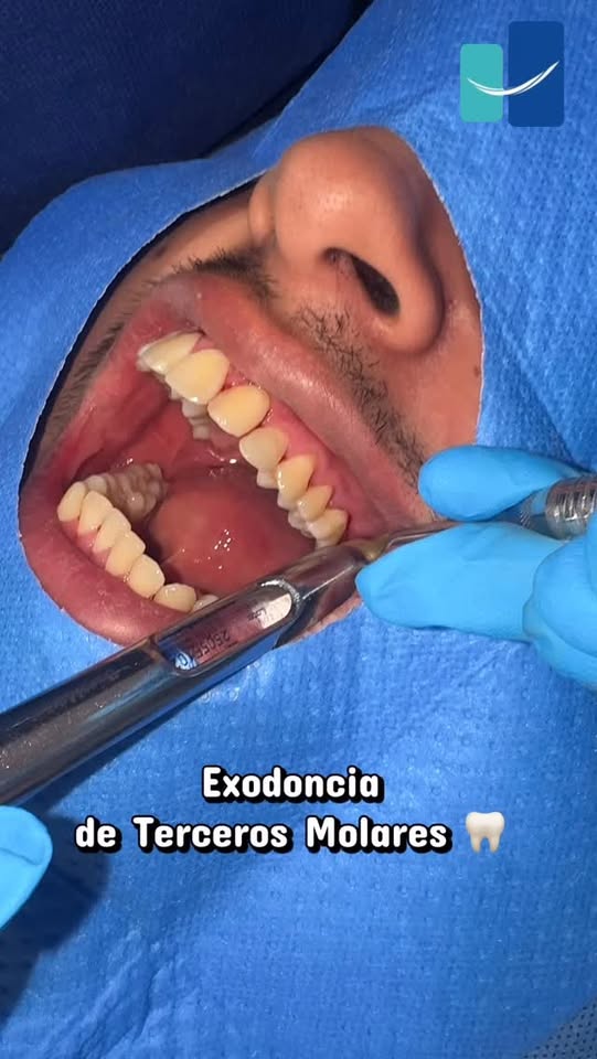 Exodoncia de terceros molares