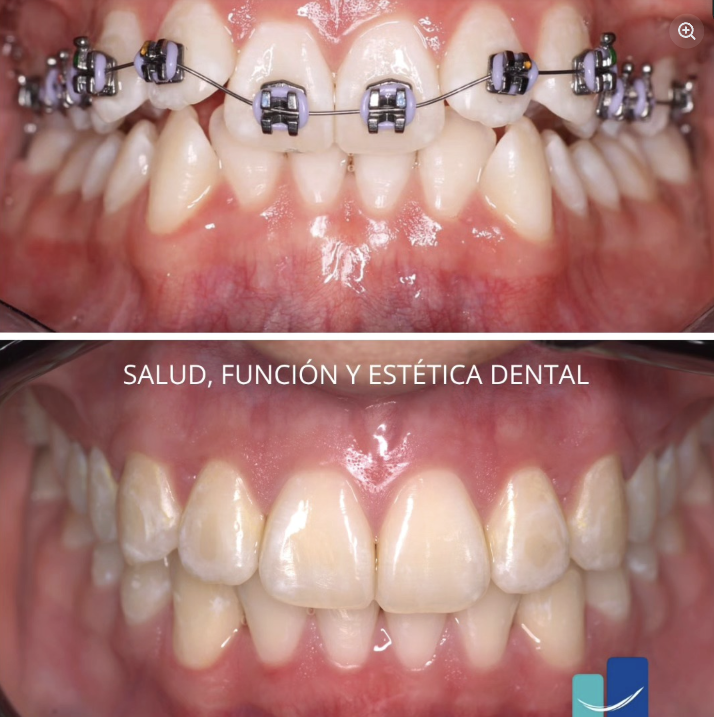 Ortodoncia · antes y después