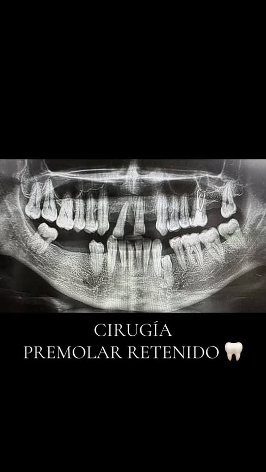 Cirugía de premolar retenido
