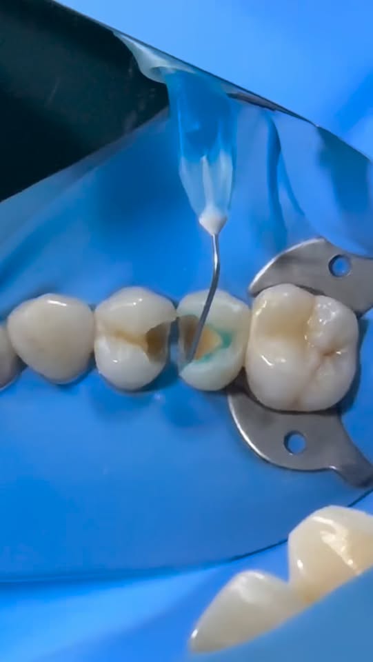 Restauración dental