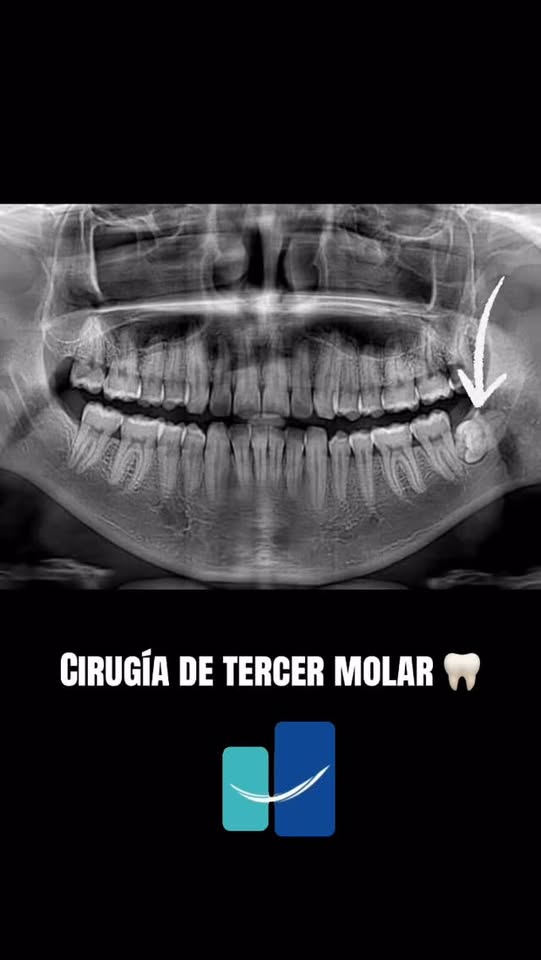 Cirugía de tercer molar